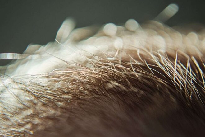 Gros plan d un cuir chevelu aux cheveux fins