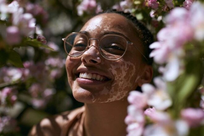 jeune femme peau vitiligo soleil fleur