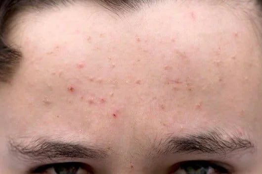 Un jeune ayant de l’acné.