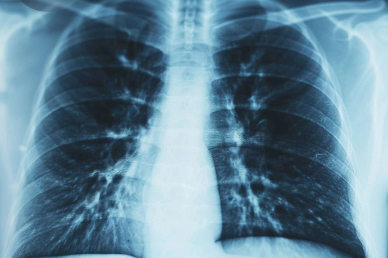 radiographie poumons